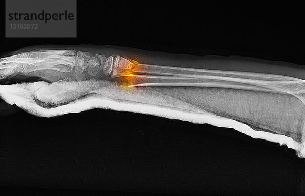 Röntgenbild der Unterarmfraktur eines 11-jährigen Jungen