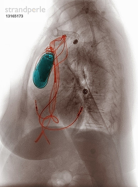 Brust-Röntgenbild mit Herzschrittmacher