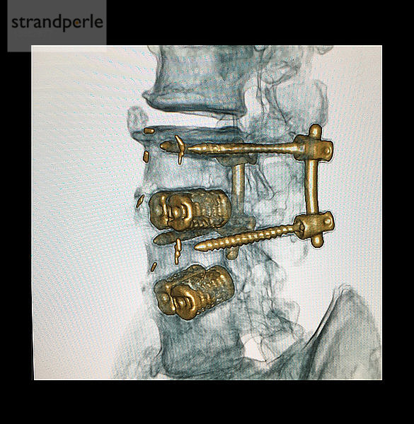 Lumbar Spinal Instrumentation,  3D CT