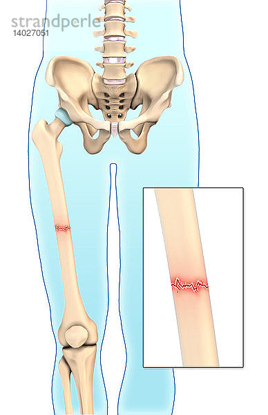 Transverse Bone Fracture,  Illustration