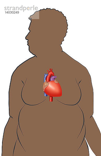 Obesity increases the risk of heart disease