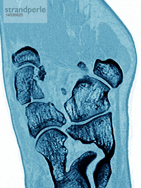 Cuneiform Bone Fracture,  CT Scan