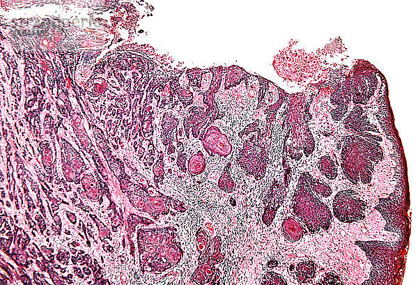Tongue cancer,  light micrograph