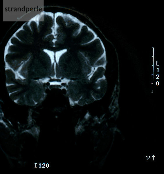 Normal MRI of brain