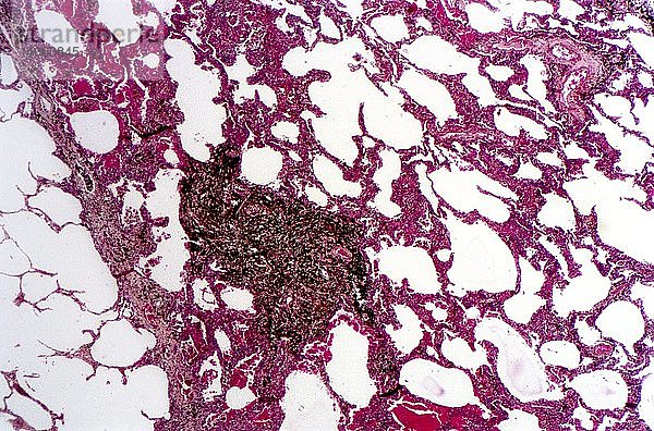 Lung cancer,  light micrograph
