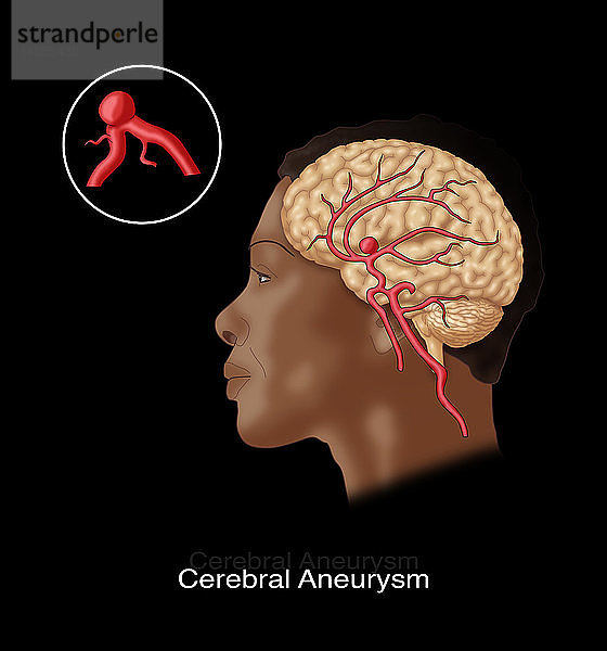 Brain Aneurysm in Situ