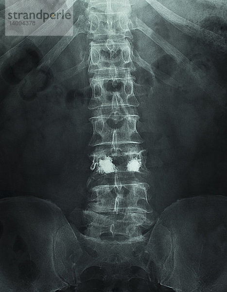 X-Ray of Kyphoplasty