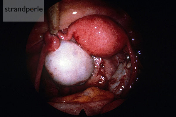 Left Ovary and Uterus